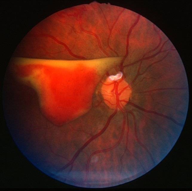 Почему появляются кровоизлияния в глаз; их виды, причины и симптомы, что делать для лечения и профилактики