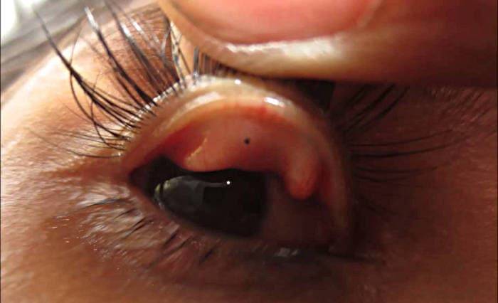Травмы глаза, их классификация и лечение