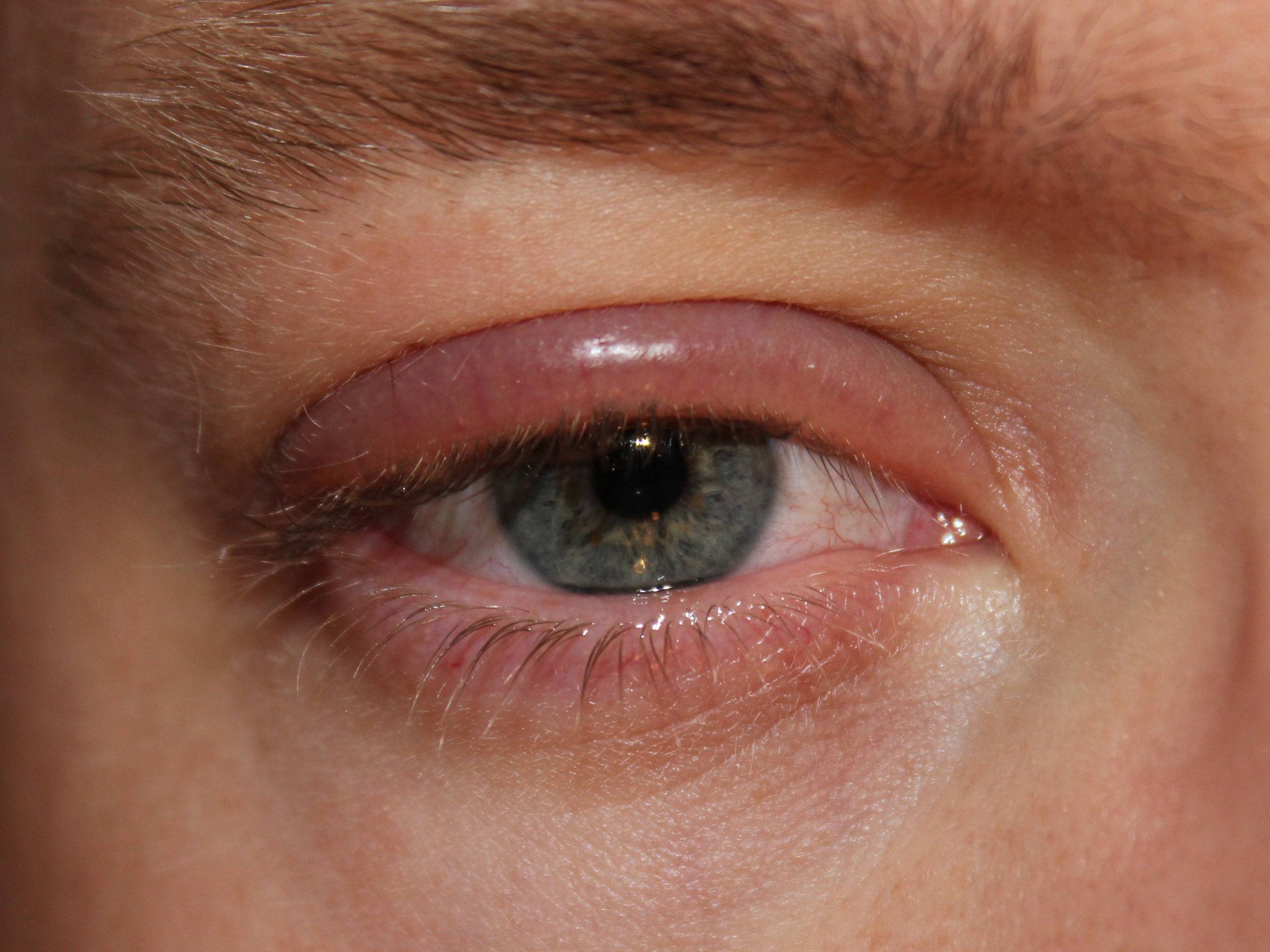 Ячмень на глазу — лечение и симптомы | как лечить ячмень на глазу