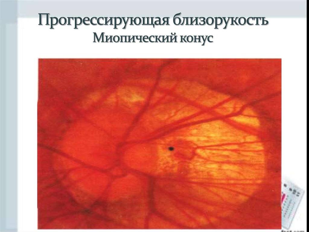 Глазное дно миопический конус. ложная и истинная миопическая стафилома сетчатки глаза. клиническая классификация миопии