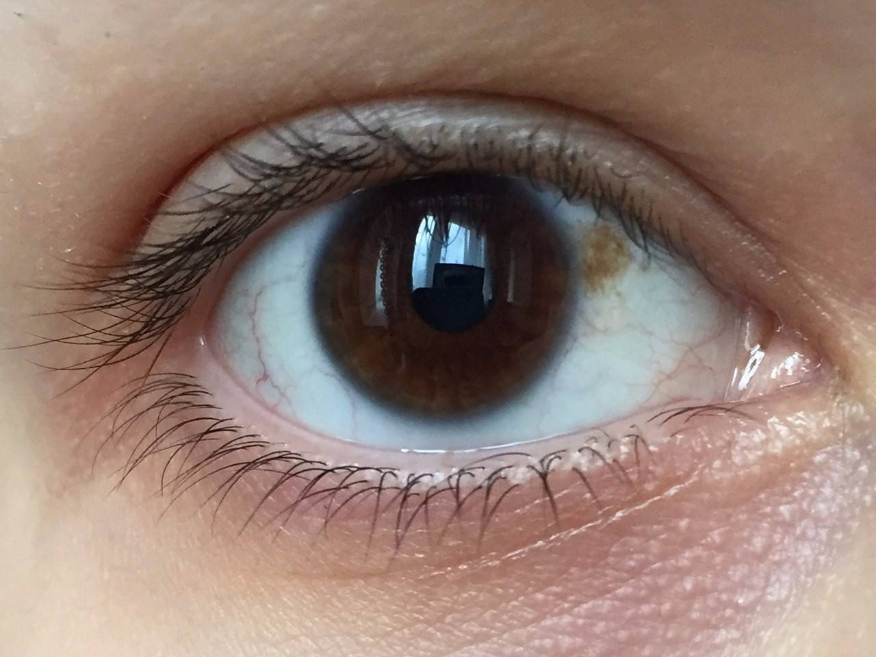 На белке глаза пузырек - что это и как лечить возникший симптом