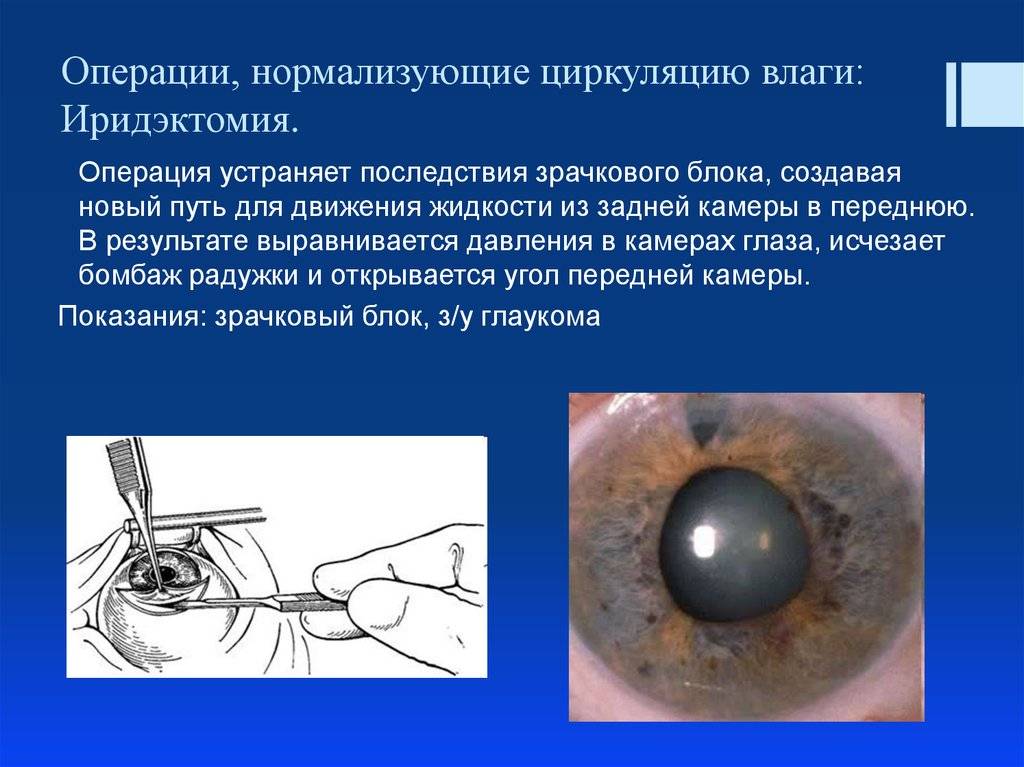 Операция глаукомы - виды лечения лазером и хирургические, противопоказания, восстановление и рекомендации, что нельзя делать после