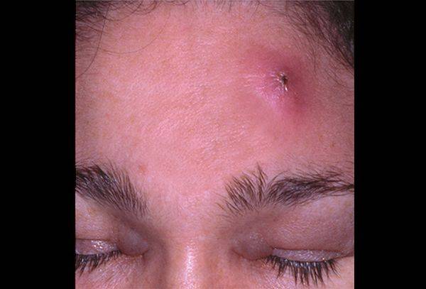 Причины, фото и лечение фурункула на глазу у взрослых и детей