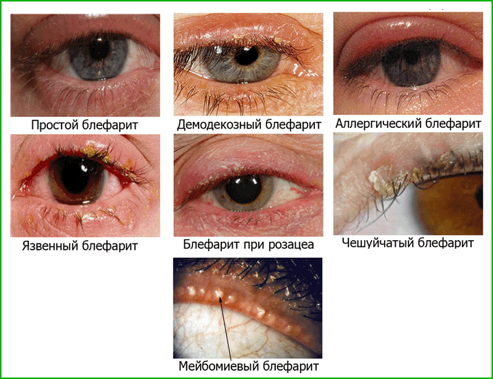 Демодекоз глаз: симптомы и лечение народными средствами