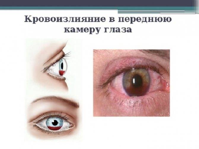 Кровоизлияние в глаз: что делать, причины и лечение, симптомы, диагностика, какие капли капать