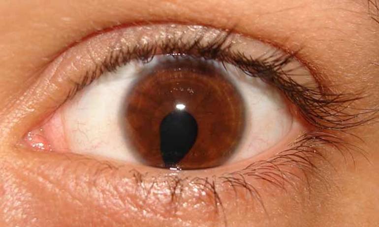 Колобома глаза, радужки, сетчатки, симптомы и причины мутации