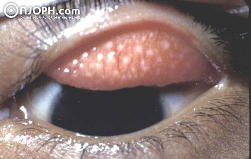 Что такое трахома и каким образом это лечить. трахома глаз: фото, симптомы, лечение, возбудитель