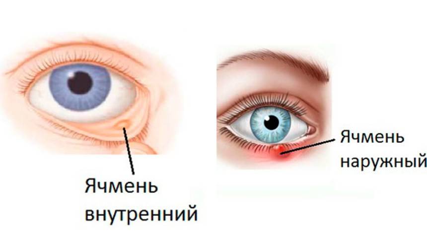 От чего появляется ячмень на глазу и как его лечить, почему появляется ячмень на глазу | медицинский портал spacehealth