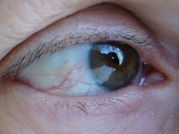 О чем расскажут пятна на глазных яблоках: виды, болезни и лечение