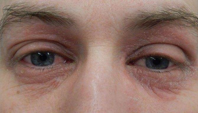 Грибковые заболевания глаз - офтальмомикозы причины появления и симптомы заболевания, какими средствами лечить