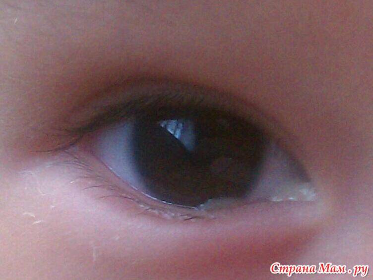 Выделения из глаз у взрослого человека и ребенка (белые, желтые, зеленые, коричневые, гнойные, слизистые), почему отделяемое скапливается в уголках, лечение