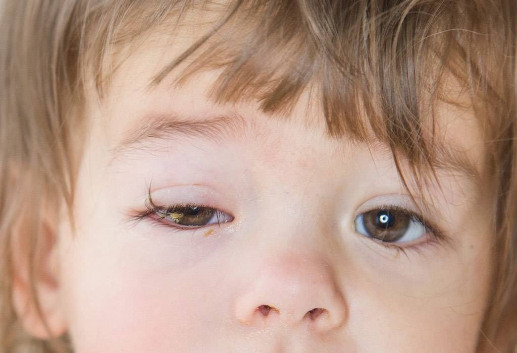Вирусный конъюнктивит у детей: лечение, как лечить аденовирусный, фото симптомов, капли и препараты для глаз