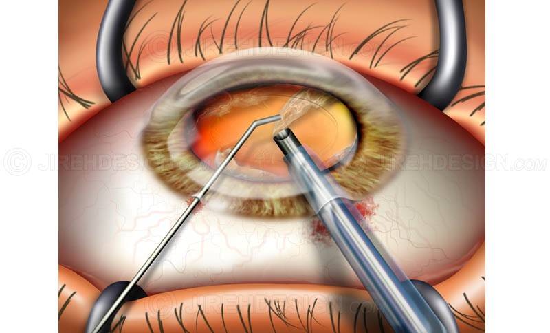 Замена хрусталика при катаракте - как проходит операция? показания и противопоказания