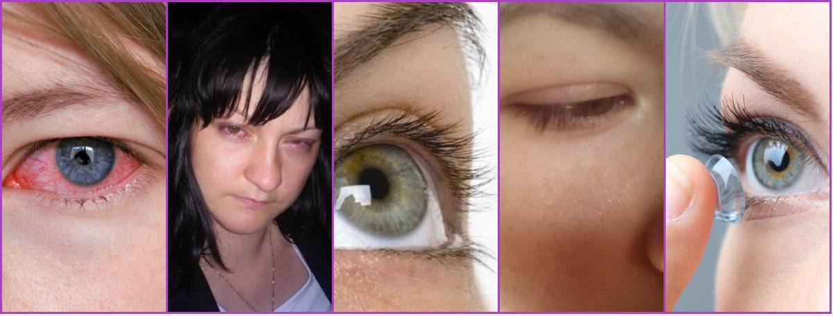 Болят глаза от линз: причины, что делать если после ношения оптики появляются неприятные ощущения