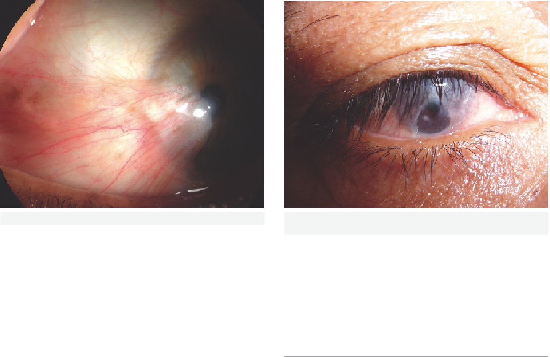 Лечение заболевания глаз птеригиум