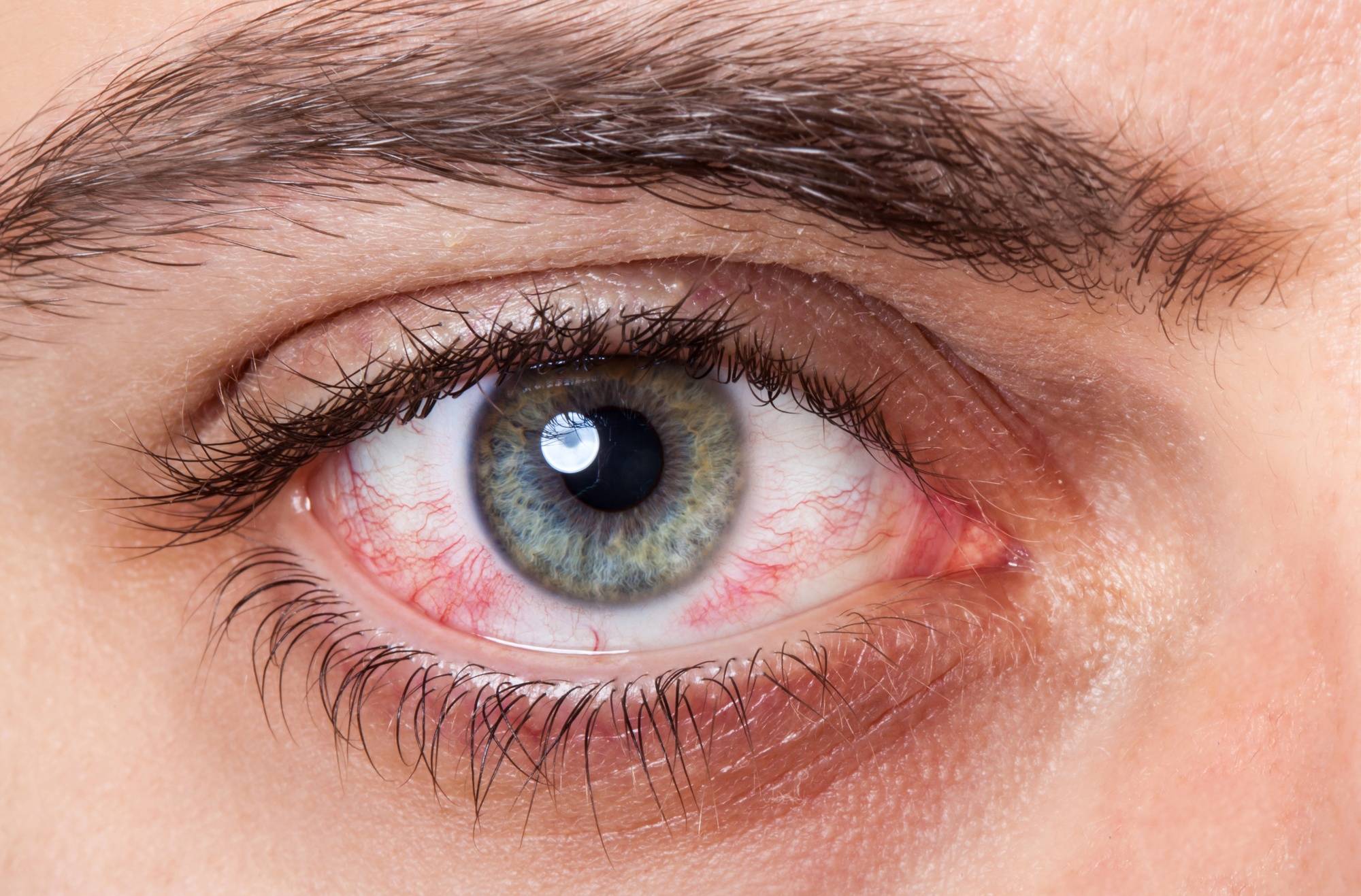 Болят глаза от линз: причины, что делать если после ношения оптики появляются неприятные ощущения