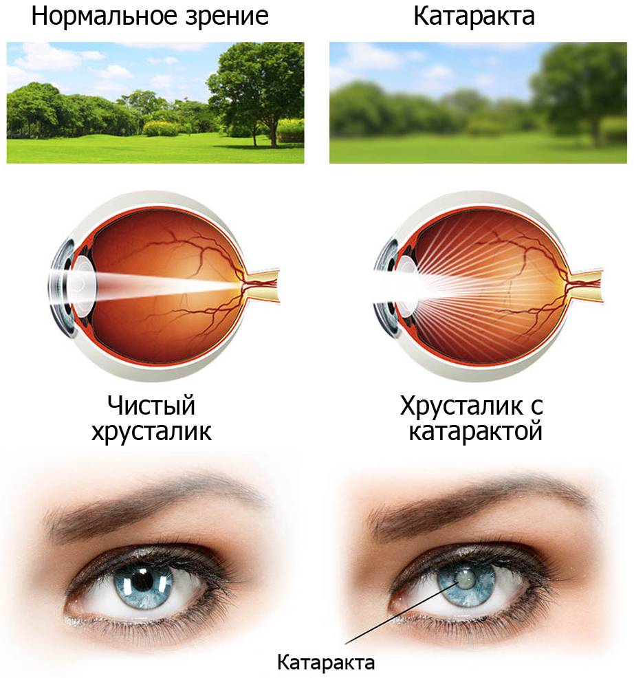 Монокулярное зрение и его отличия от бинокулярного