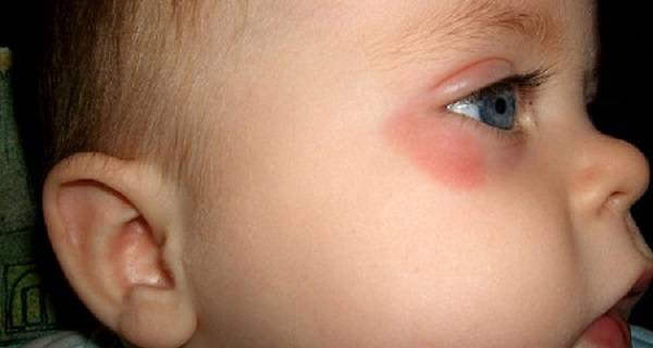 Красные пятна под глазами у ребенка: причины и методы лечения - "здоровое око"