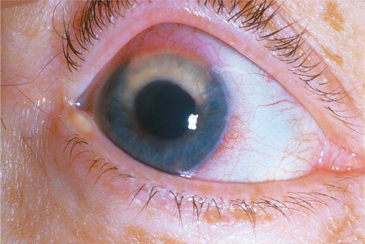 Хрусталик глаза - строение, функции, заболевания - "здоровое око"