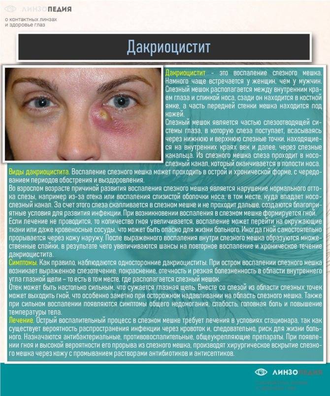 Воспаление слёзной железы: симптомы и лечение oculistic.ru
воспаление слёзной железы: симптомы и лечение