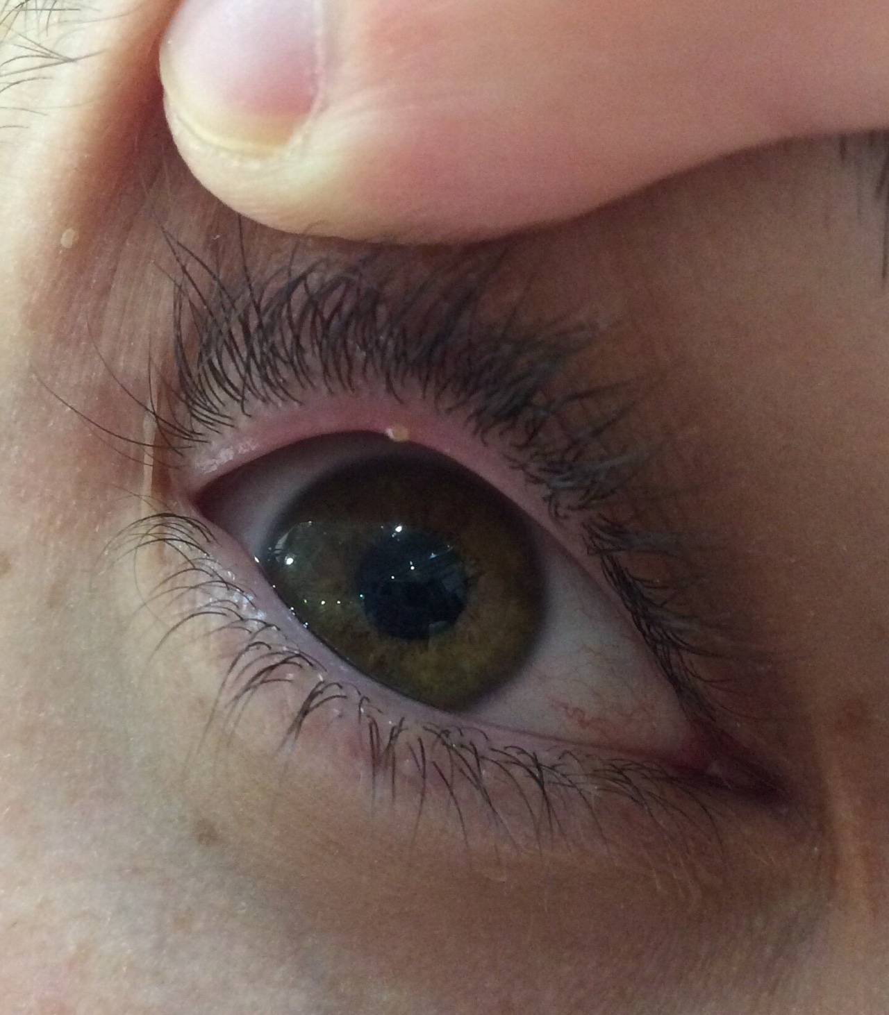 Глаз красный и гноится: почему так происходит и чем лечить симптом у взрослого