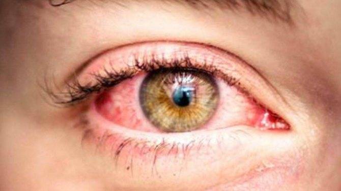 Как снять красноту глаз в домашних условиях