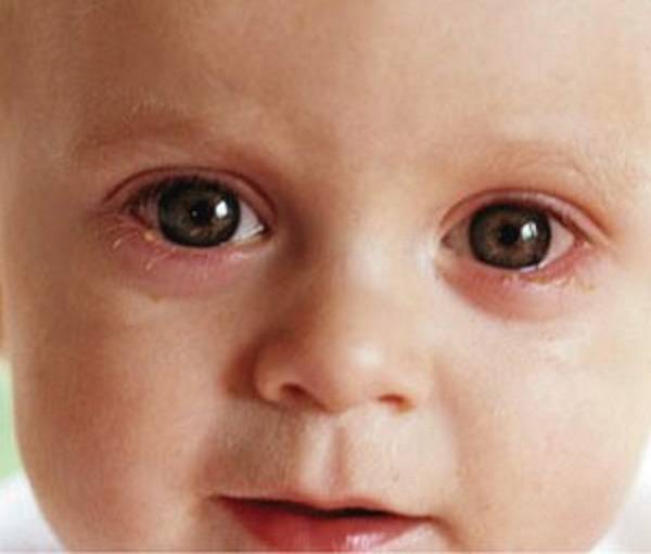 Красные глаза у новорожденного: причины, методы диагностики и лечения
