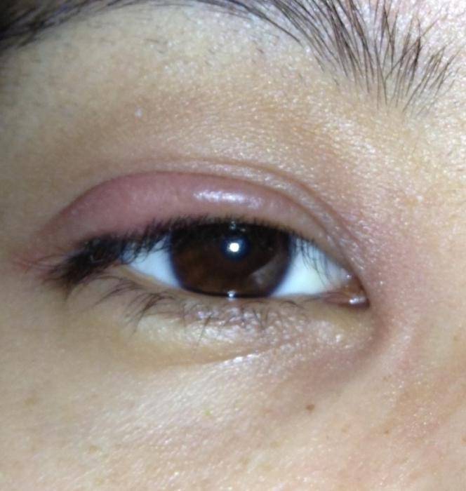 Опух глаз (нижнее веко) на одном или обоих глазах: способы лечения