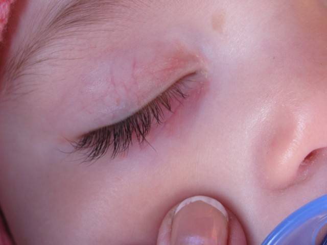 Красный белок глаза у ребенка и сосуды - причины покраснения капилляров на глазах и прожилок, точки в уголках