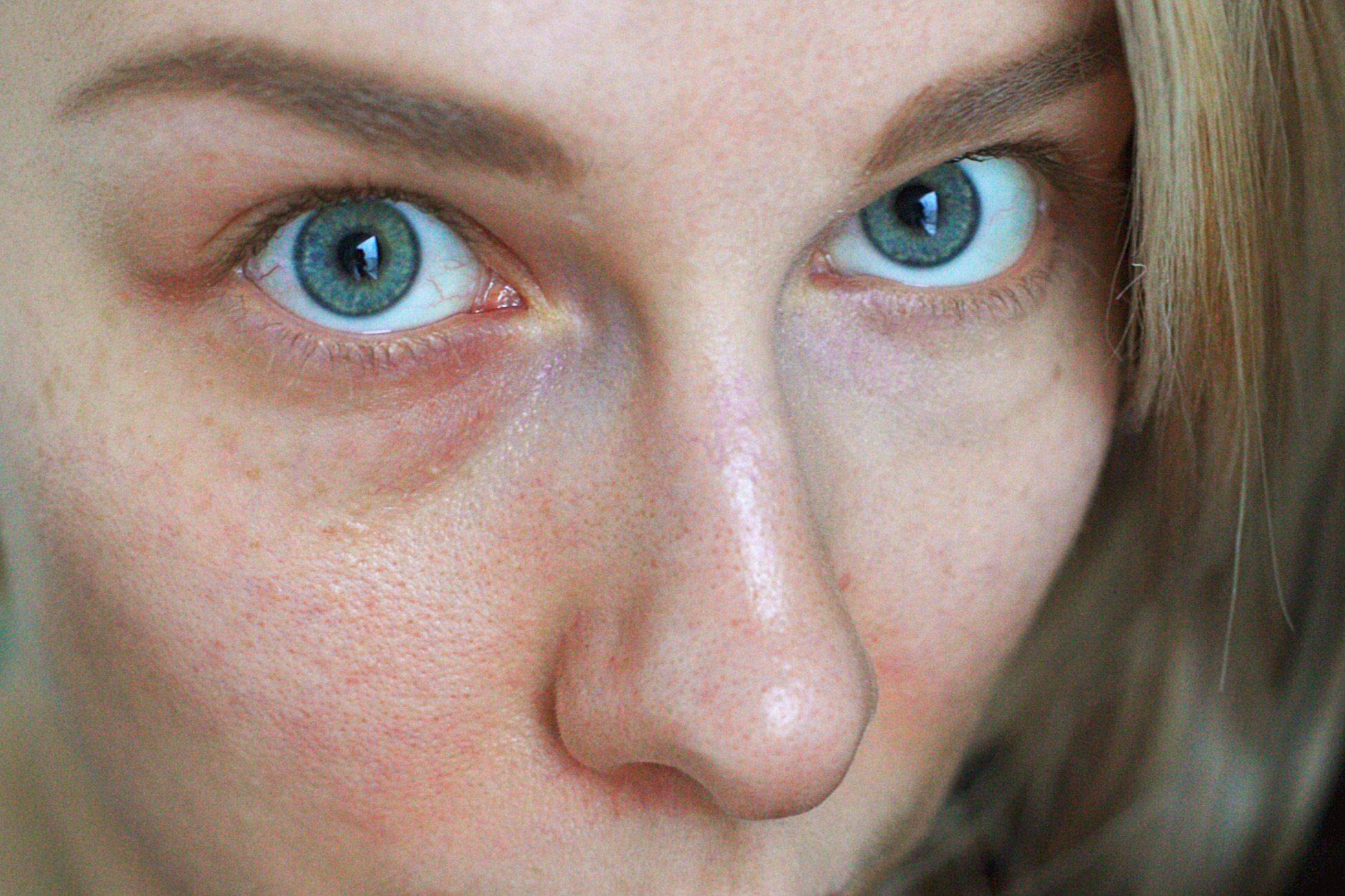 Красные круги под глазами почему. причины возникновения симптома у взрослых | школа красоты