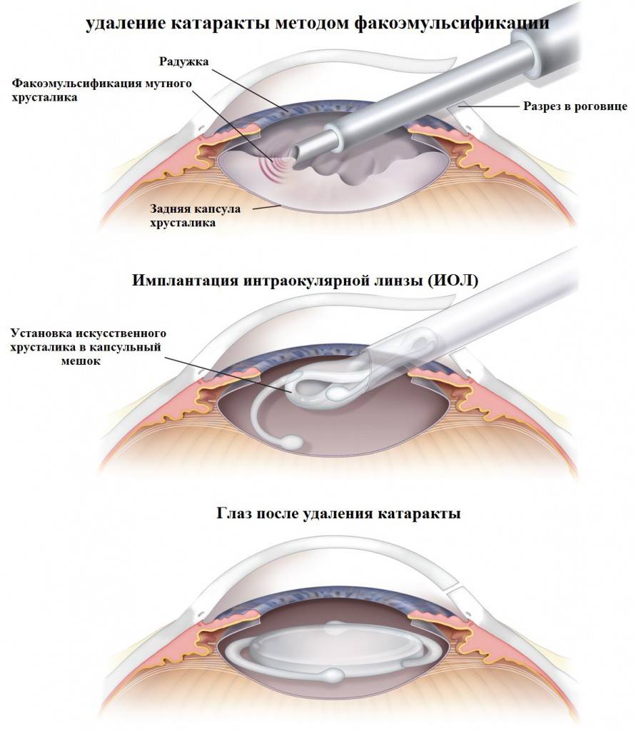 Энуклеация глазного яблока: операция по удалению глаза у человека - как проводится