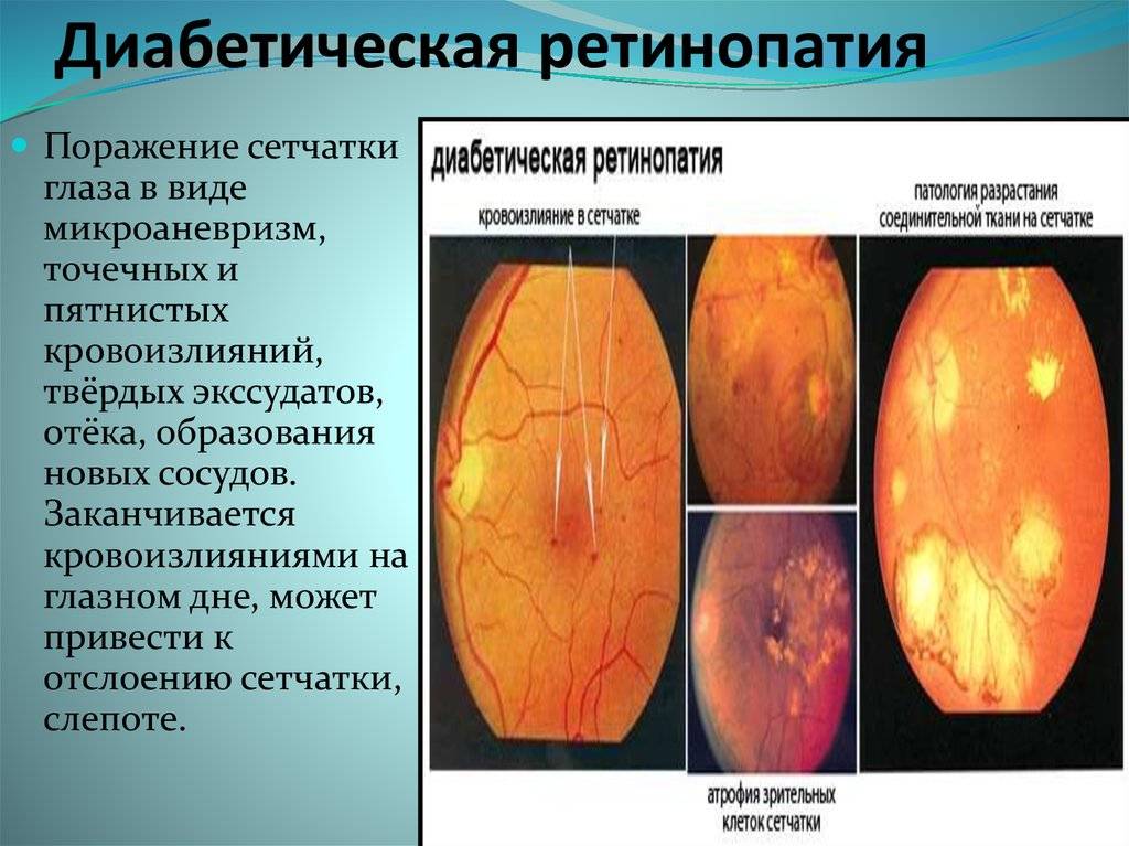 Диабетическая ретинопатия: особенности течения и терапии опасного осложнения сахарного диабета