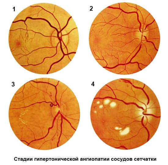 Ангиопатия сетчатки глаза у ребенка