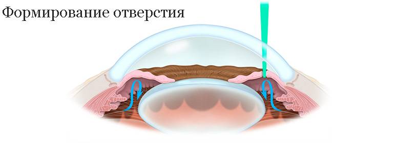 Лазерная иридэктомия при глаукоме – все об операции