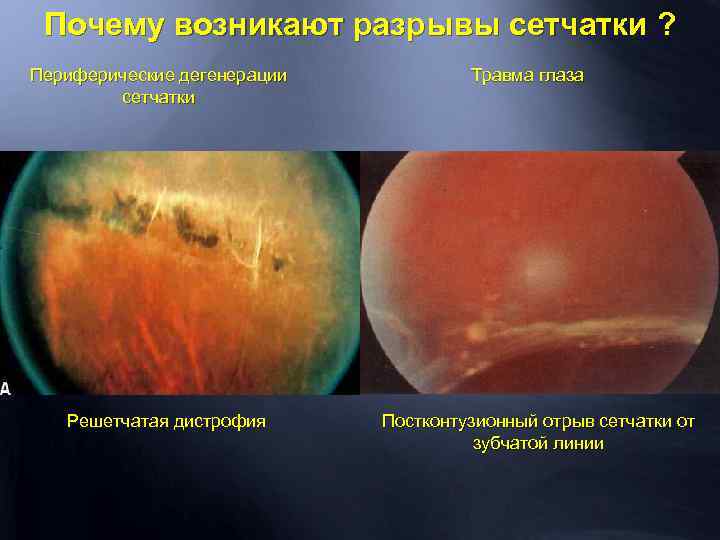 Периферическая хориоретинальная дистрофия сетчатки (пхрд глаза) — что это такое?