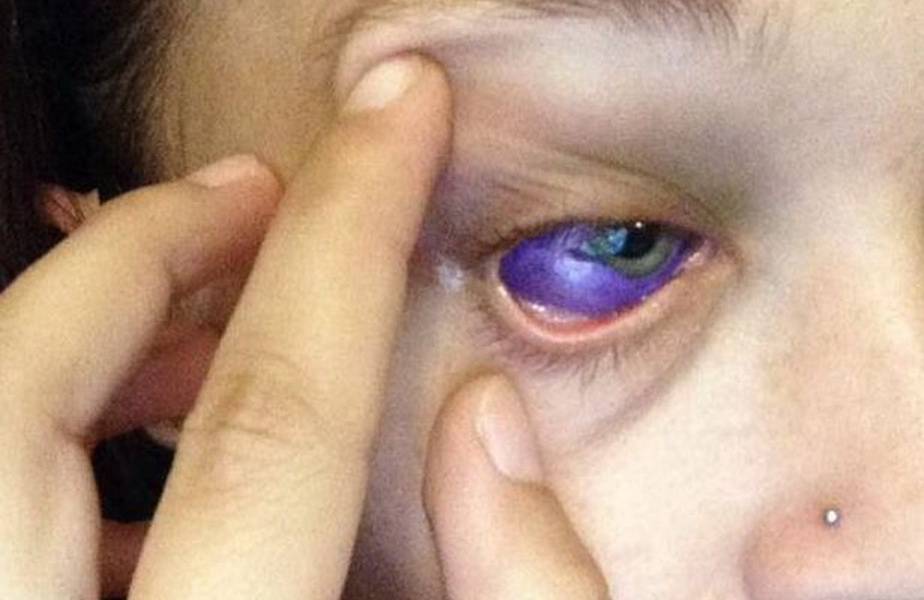 Вытек глаз - как происходит вытекание, первая помощь