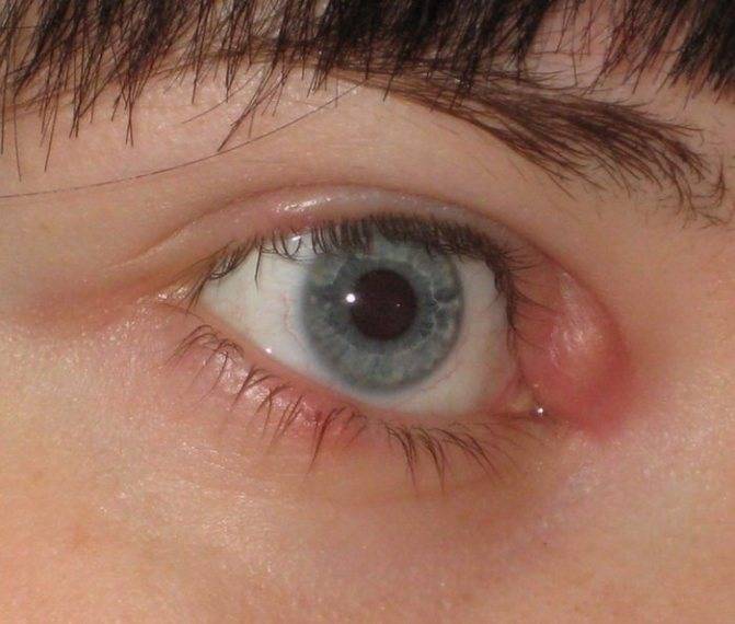 Ячмень на глазу: причины и лечение