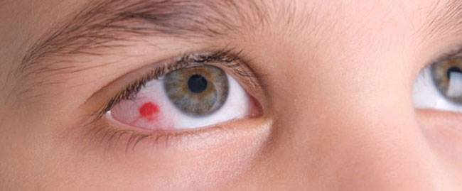 Почему у ребенка красные глаза — что делать