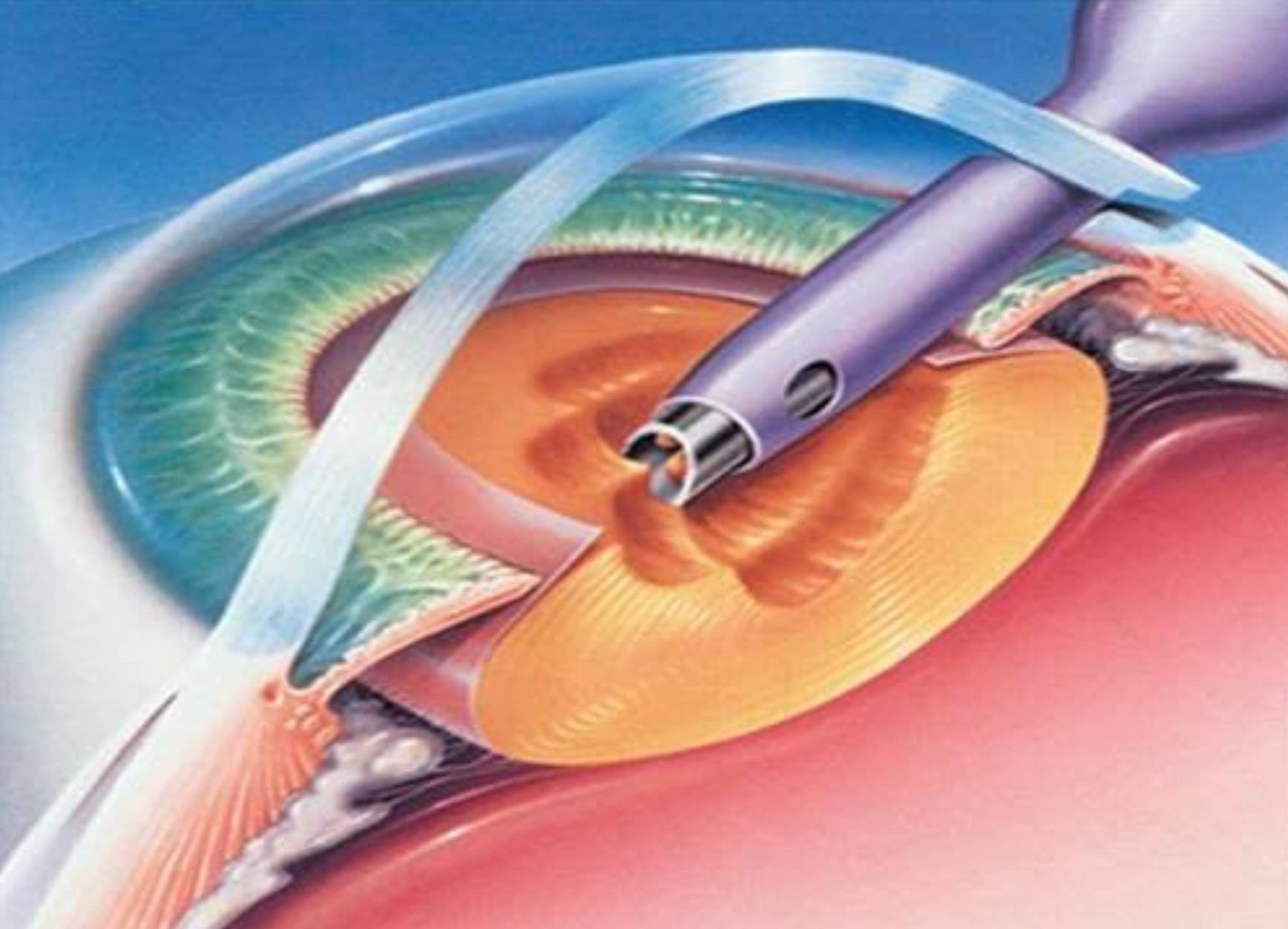 Замена хрусталика глаза: операция, цены, отзывы, при катаракте