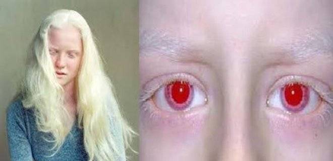 Глазокожный альбинизм: что это такое, симптомы, лечение, прогноз