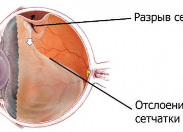 Отслоение сетчатки глаза — операция и отзывы пациентов