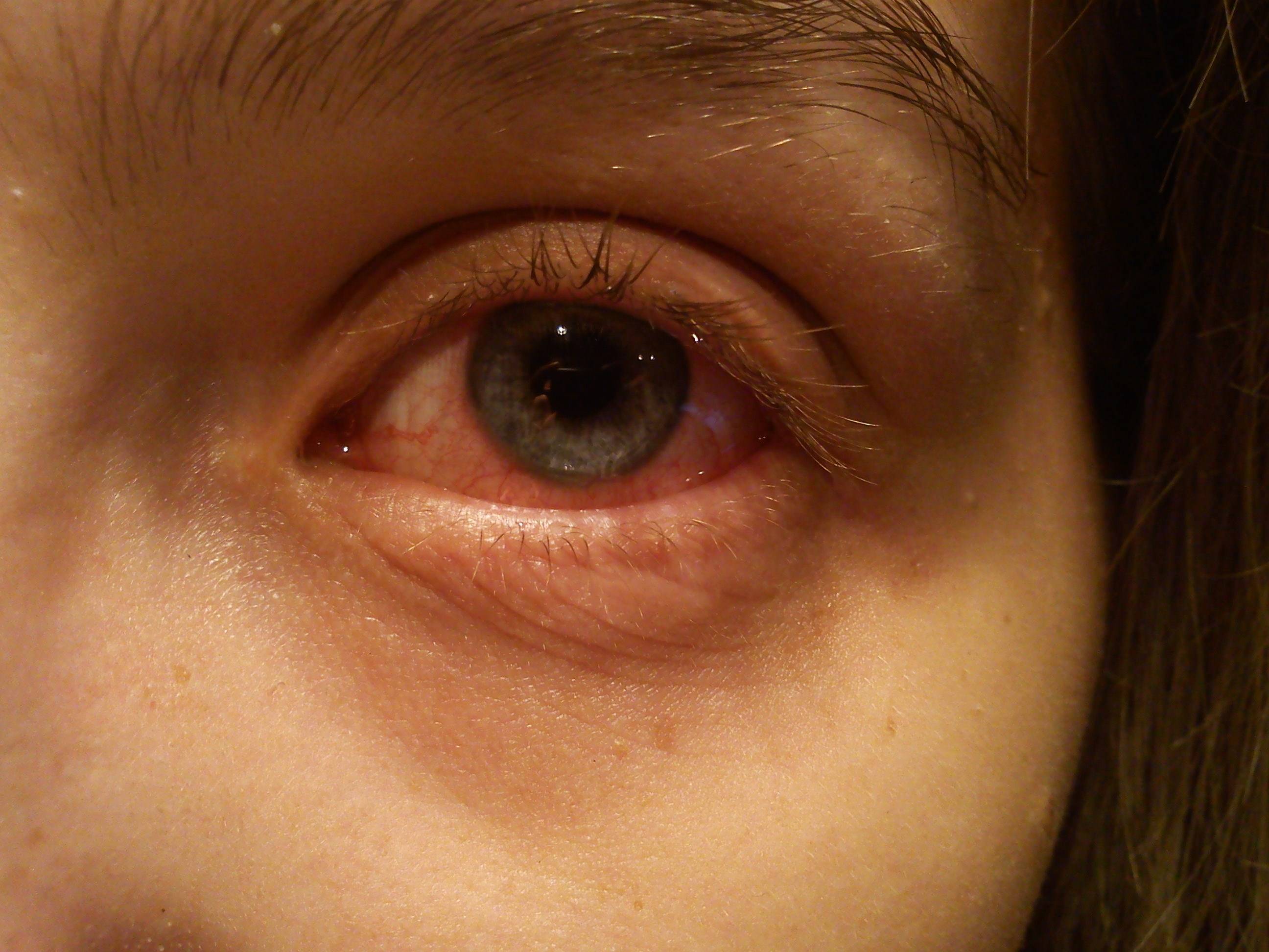 При простуде у ребенка красные глаза: причины, лечение