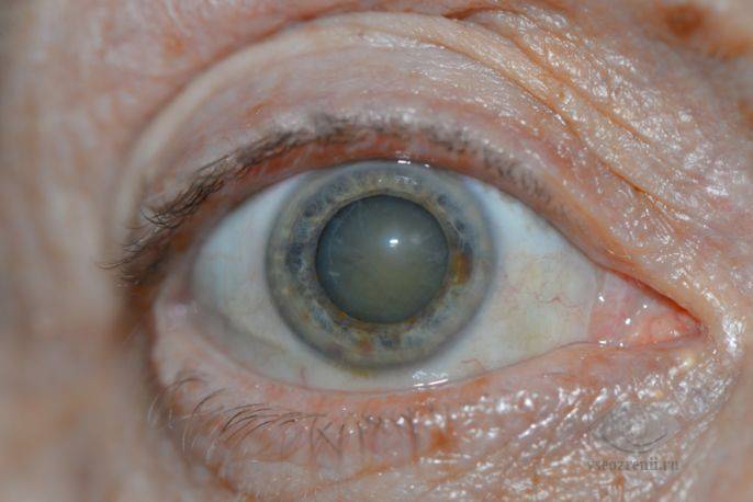 Операция при катаракте глаза: суть, цены, реабилитация