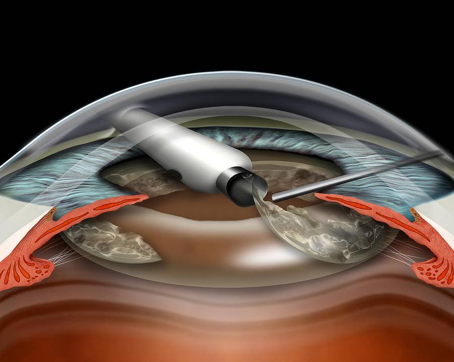 Послеоперационный период после катаракты - замены хрусталика глаза