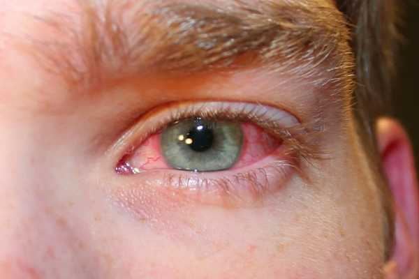 Покраснение глаз, причины и лечение, эффективные препараты