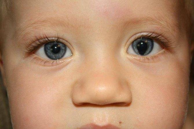 Разные по размеру зрачки у ребенка - причины анизокории