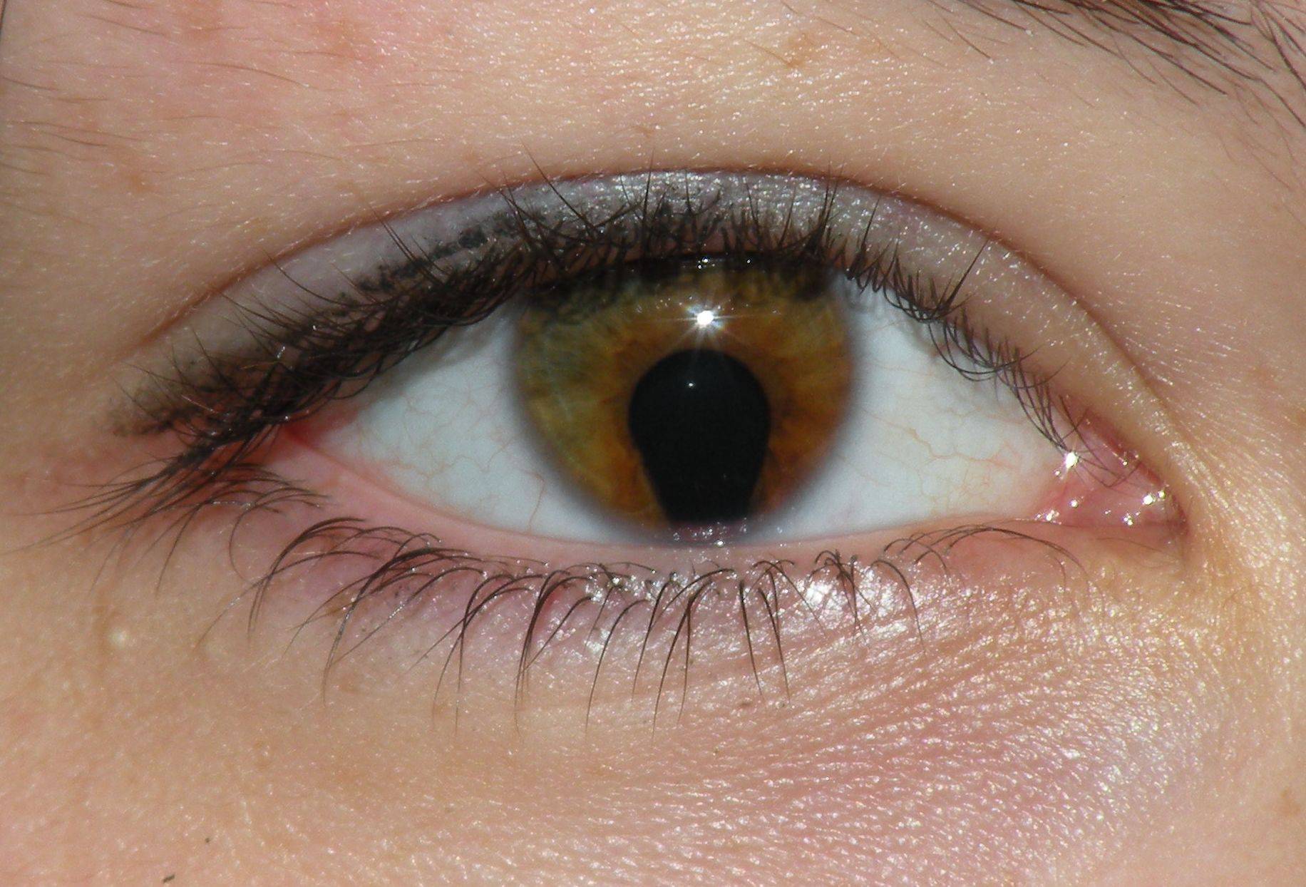 Бельмо на глазу у человека (лейкома): причины, лечение, симптомы (фото), что такое