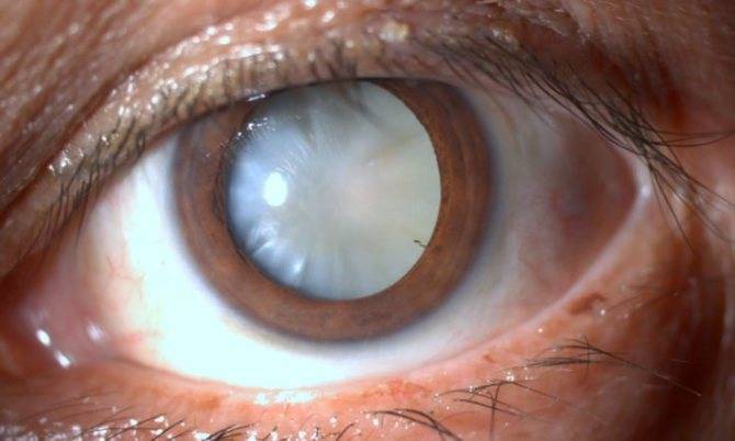 Вторичная катаракта после замены хрусталика: лечение лазером, причины повторного возникновения, противопоказания, диагностика, симптомы, прогноз и профилактика