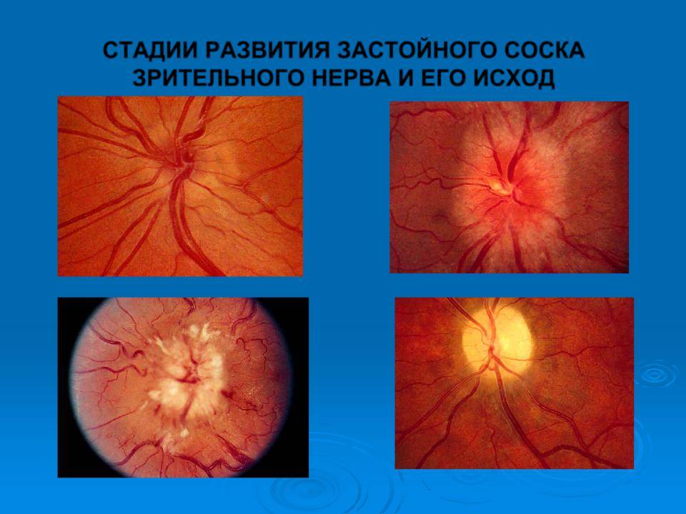 Застойный диск зрительного нерва - "здоровое око"