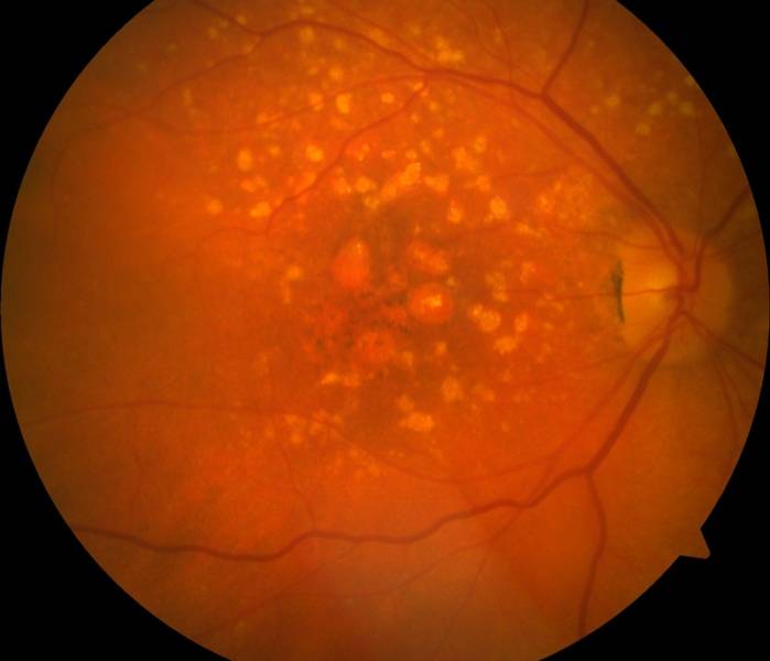 Лечение макулодистрофии сетчатки глаза - рекомендации, средства и продукты для улучшения зрения при сухой и влажной форме